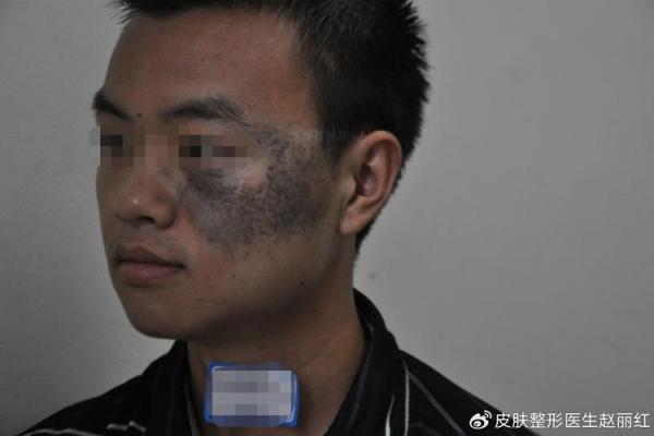 眼睛上的胎记算命分析