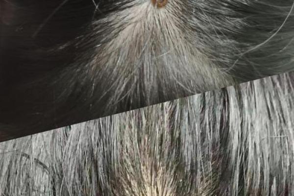 头上长瘊子好不好算命 头上长瘊子好不好算命